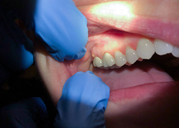 Best Emergency Dental Care for Sports Injuries in Lake Mawk, OH
